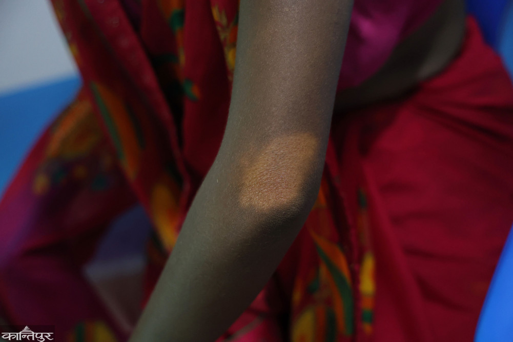 Leprosy patients are increasing in Kapilvastu
