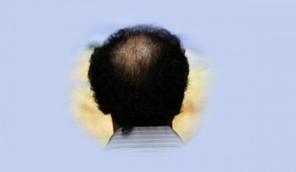 Do you have hair loss problem? These may be solutions