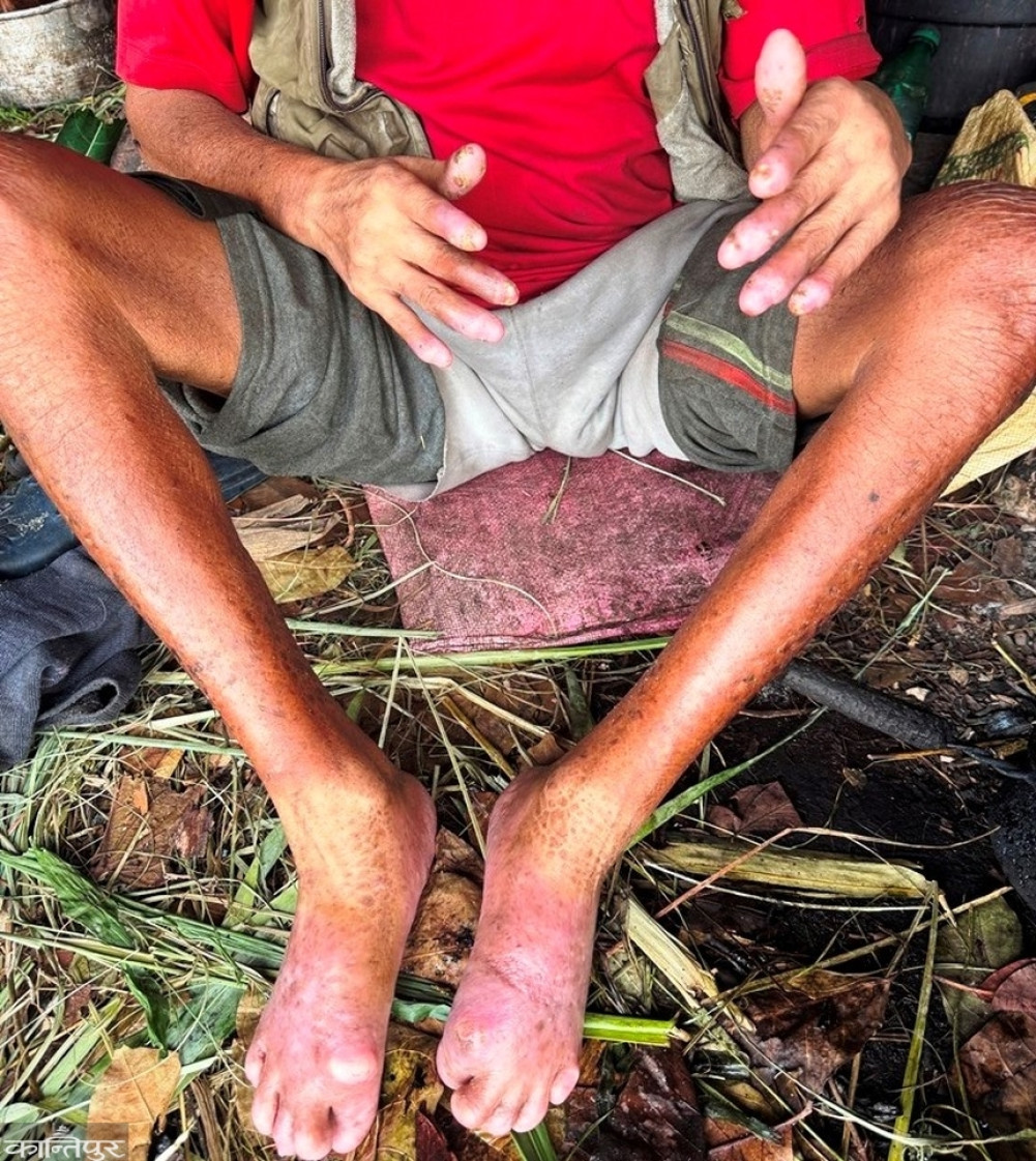 Treatment for an elderly man who has been living in a barn for 5 years with rotting limbs
