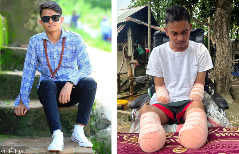 Umesh's pain: He went abroad for his family, but returned after losing a limb.