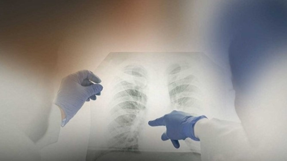 Tuberculosis and Nepal's efforts for its management